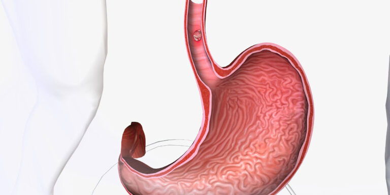 sleeve-gastrectomy