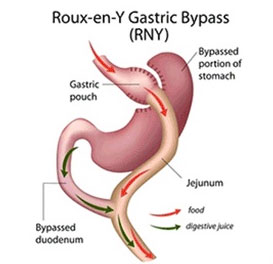 gastric bypass surgery