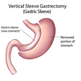 gastric sleeve